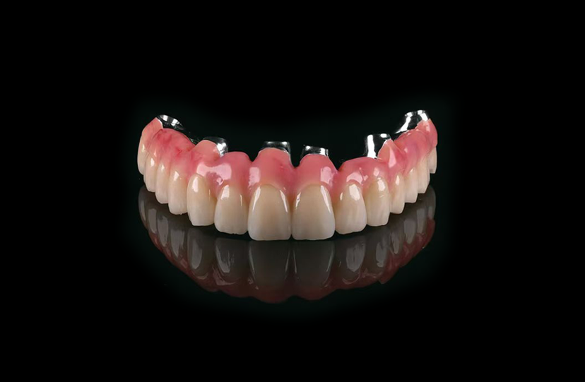 Milled Titanium Bridge with Individual Crowns